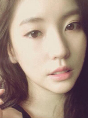 埋埋蛋白線.提升術(shù)后恢復(fù)記錄分享還有對(duì)比照