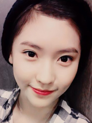 埋埋蛋白線.提升術(shù)后恢復(fù)記錄分享還有對(duì)比照