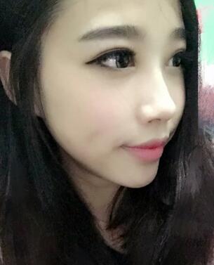 全割雙眼皮恢復(fù)日記 全切雙眼皮+開眼角