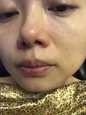 做了高強度聚焦超聲，果還不錯，想把經(jīng)歷分享給大家