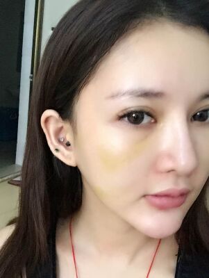 面部埋埋蛋白線.提升術(shù)后照片，皮膚緊致不少了