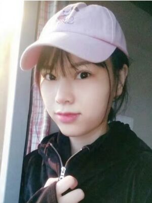 隆鼻整形真實恢復(fù)期圖片，大鼻子終于變秀氣了