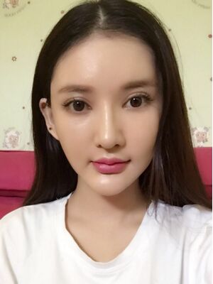 面部埋埋蛋白線.提升術(shù)后照片，皮膚緊致不少了