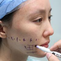 蛋白線面部埋埋蛋白線.提升手術價格15000元，果不錯分享給大家