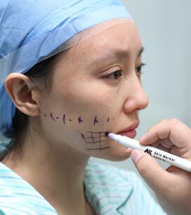 面部埋埋蛋白線.提升手術(shù)過程分享