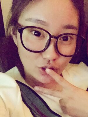 雙眼皮失敗修復(fù)手術(shù)恢復(fù)前后對比圖