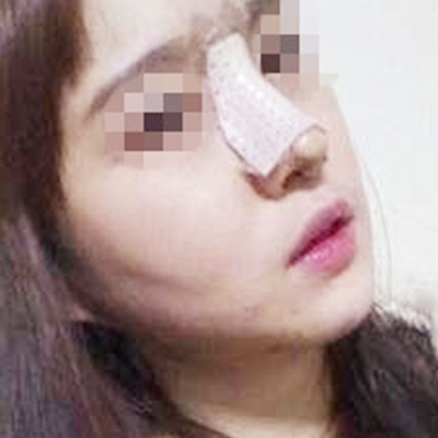 上海九院戴傳昌硅膠假體隆鼻案例