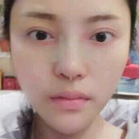 假體隆鼻15天后恢復(fù)圖，隆鼻果自然