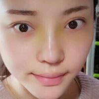 假體隆鼻15天后恢復(fù)圖，隆鼻果自然