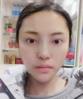 假體隆鼻15天后恢復(fù)圖，隆鼻果自然