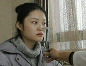 假體隆鼻15天后恢復(fù)圖，隆鼻果自然