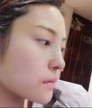 假體隆鼻15天后恢復(fù)圖，隆鼻果自然