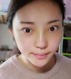 假體隆鼻15天后恢復(fù)圖，隆鼻果自然