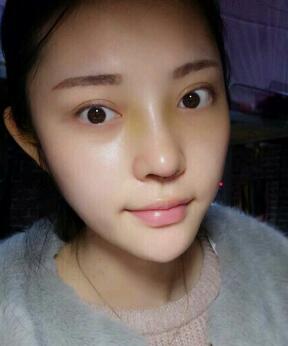 假體隆鼻15天后恢復(fù)圖，隆鼻果自然