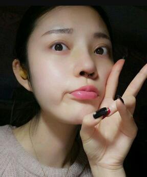 假體隆鼻15天后恢復(fù)圖，隆鼻果自然