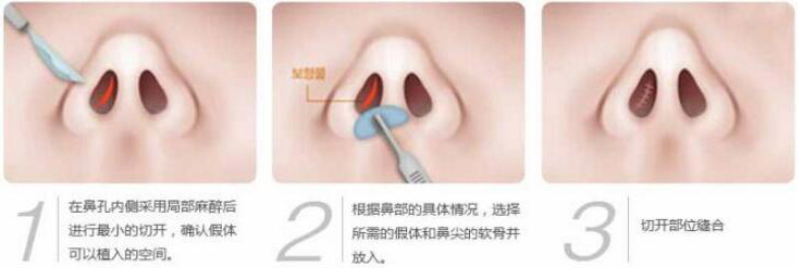 硅膠假體隆鼻過(guò)程和隆鼻前后圖片，真實(shí)案例分享