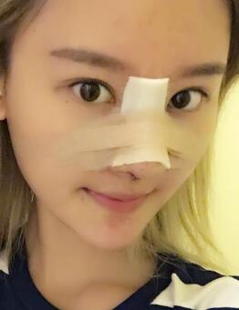 硅膠假體隆鼻過(guò)程和隆鼻前后圖片，真實(shí)案例分享