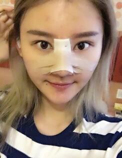硅膠假體隆鼻過(guò)程和隆鼻前后圖片，真實(shí)案例分享