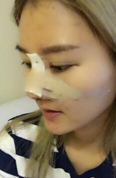硅膠假體隆鼻過(guò)程和隆鼻前后圖片，真實(shí)案例分享
