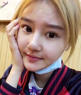 硅膠假體隆鼻過(guò)程和隆鼻前后圖片，真實(shí)案例分享