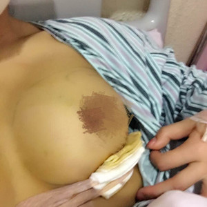 50000元做的自體脂肪隆胸，還有前后對比照片以及注意事項哦