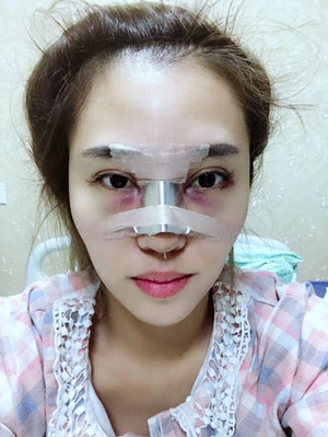 長沙華韓華美做的隆鼻整形，感覺果還不錯哦!