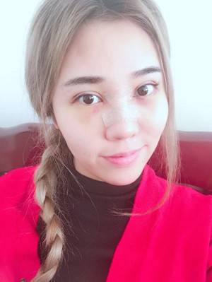 長沙華韓華美做的隆鼻整形，感覺果還不錯哦!