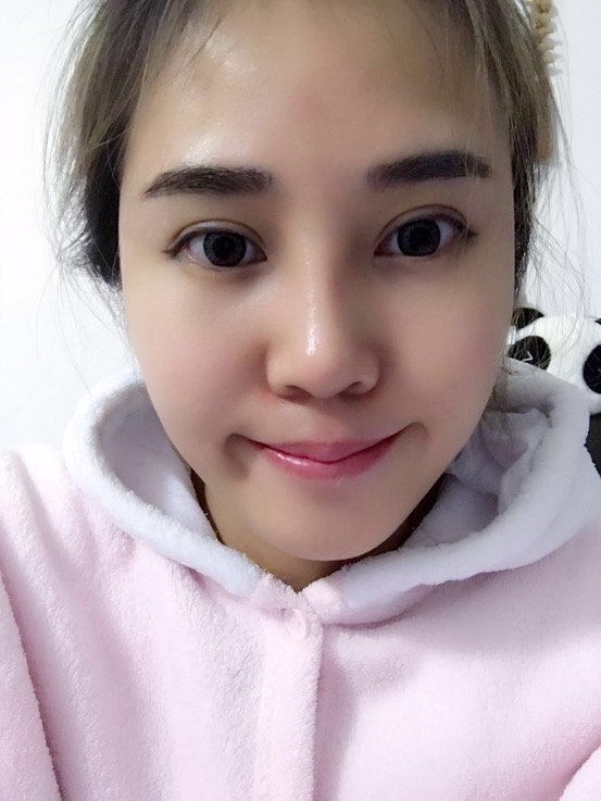 長沙華韓華美做的隆鼻整形，感覺果還不錯哦!