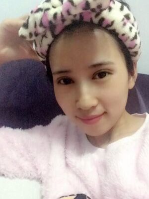 切開雙眼皮恢復(fù)過程，手術(shù)很成功哦