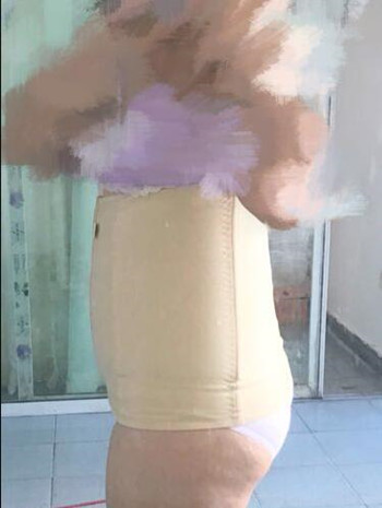 腰腹吸脂整形花了我兩萬多的錢  果真的挺不錯(cuò)的