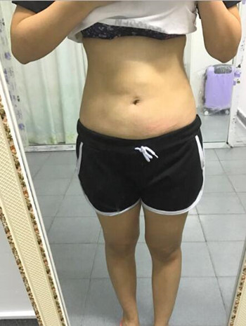 腰腹吸脂整形花了我兩萬多的錢  果真的挺不錯(cuò)的