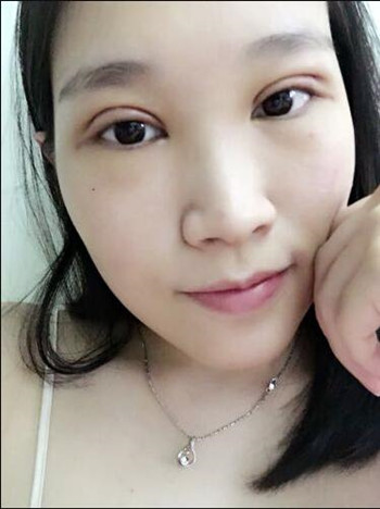 做全切雙眼皮花了8000多 整體恢復果真的很棒