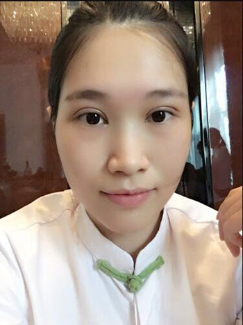 做全切雙眼皮花了8000多 整體恢復果真的很棒