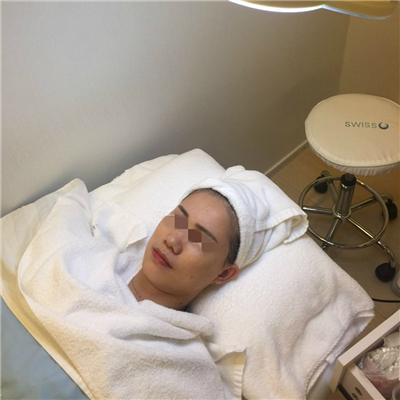 杭州格萊美徐云喜激光去黃褐斑案例