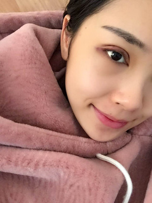 你們看看我做的歐式大雙眼皮怎么樣