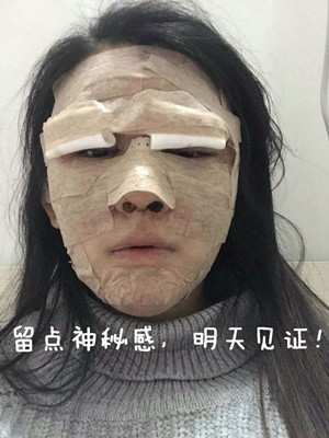 做了詳細(xì)部脂肪填充+雙眼皮+假體隆鼻，來看看果如何
