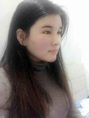 做了詳細(xì)部脂肪填充+雙眼皮+假體隆鼻，來看看果如何
