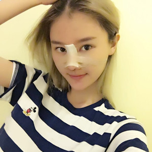 硅膠隆鼻2個月啦，8000元做的哦!