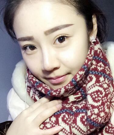 耳軟骨墊鼻尖三個月圖 耳軟骨墊鼻尖+硅膠隆鼻