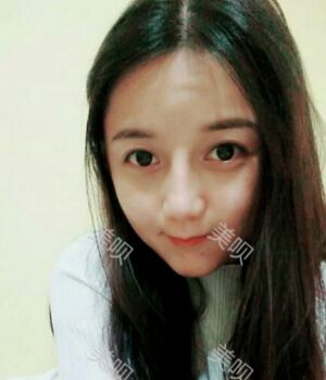 韓式隆鼻整形真實恢復(fù)期圖片，自然不夸張