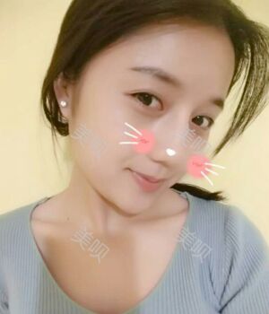 韓式隆鼻整形真實恢復(fù)期圖片，自然不夸張