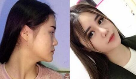 隆鼻前后對比圖