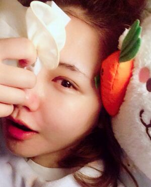 韓式定點雙眼皮前后對比圖，雙眼有神多了