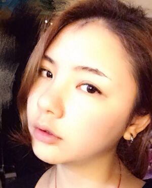 韓式定點雙眼皮前后對比圖，雙眼有神多了