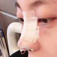 鼻子整形過程恢復(fù)圖片，真實(shí)案例分享