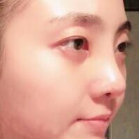 鼻子整形過程恢復(fù)圖片，真實(shí)案例分享