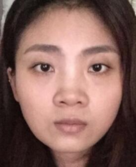 鼻子整形過程恢復(fù)圖片，真實案例分享
