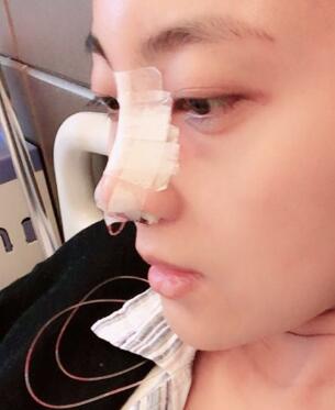 鼻子整形過程恢復(fù)圖片，真實案例分享