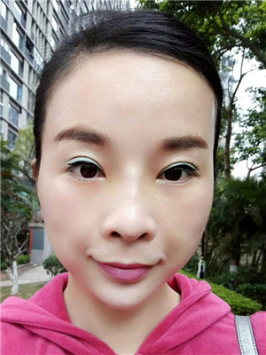 你們來看看我的面部埋埋蛋白線.提升術(shù)恢復(fù)情況