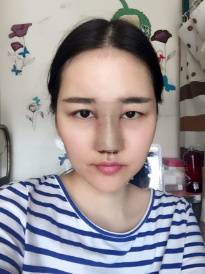 給你們分享隆鼻整形手術(shù)恢復(fù)過程